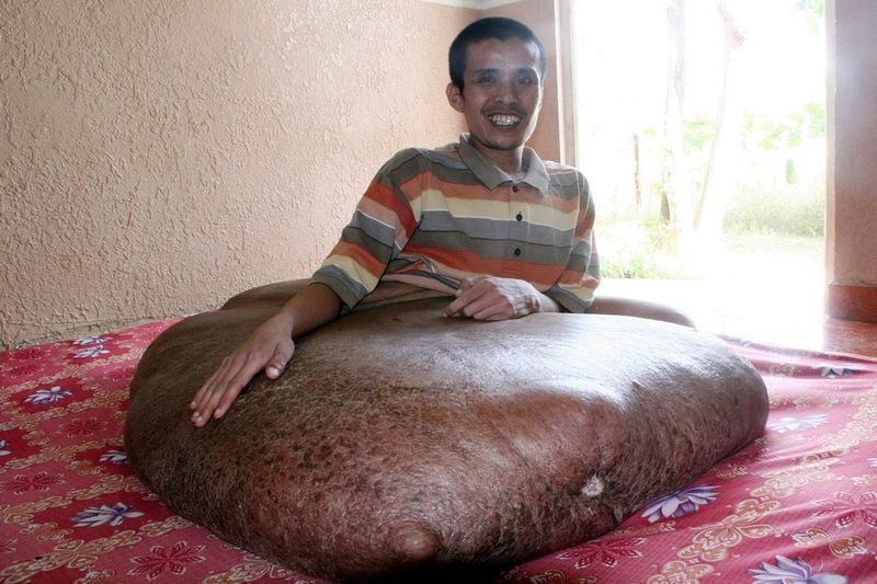 На ноге вьетнамца выросла 80-килограммовая опухоль ( 5 фото)