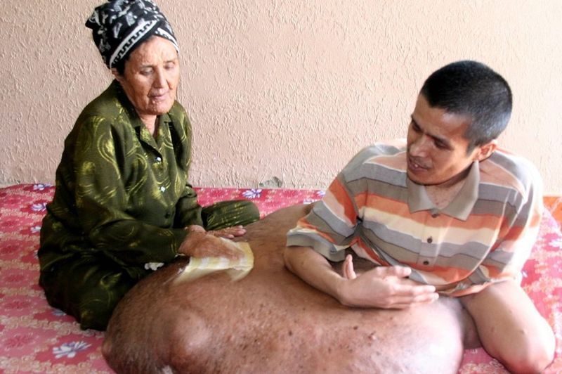 На ноге вьетнамца выросла 80-килограммовая опухоль ( 5 фото)