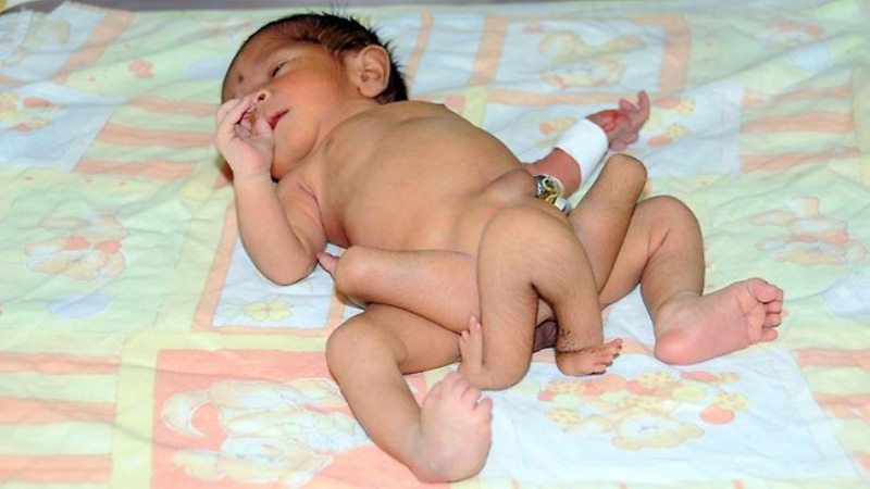 В Пакистане родился ребенок с шестью ногами (4 фото + 1 видео)