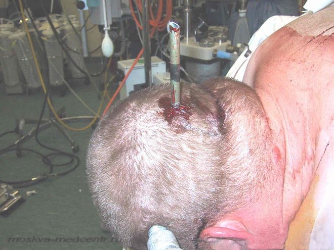 Ранение стрелой в голову (4 фото)