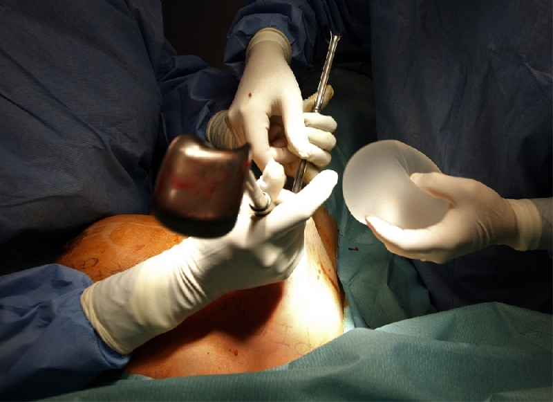 Замена грудных силиконовых имплантатов (13 фото)