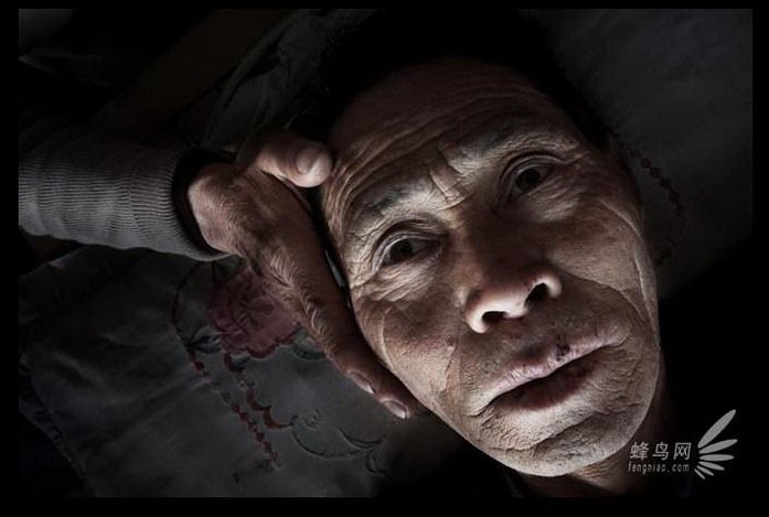 У 66-летнего Джао Куна из окрестностей Вуганга рак пищевода на поздней стадии. Каждый день его мучает лихорадка.