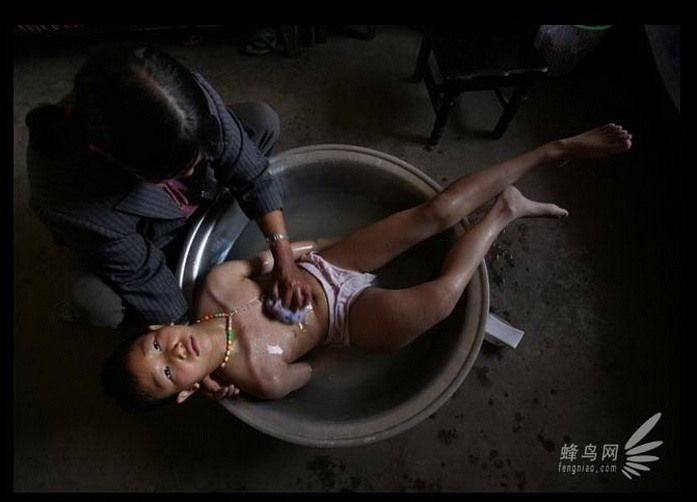 В поселке Хуаньвэй (провинция Юньнань) каждый год от рака умирают более 20 человек. 11-летний Сюй Ли страдает раком костей.