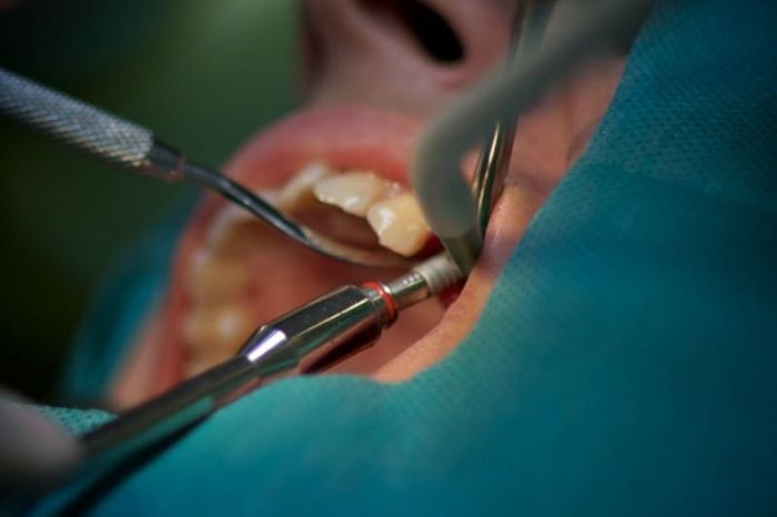 Как делают имплантацию зубов (33 фото)