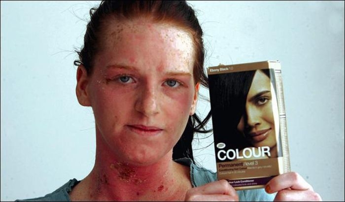 Краска для волос, вызывающая аллергическую реакцию (6 фото)