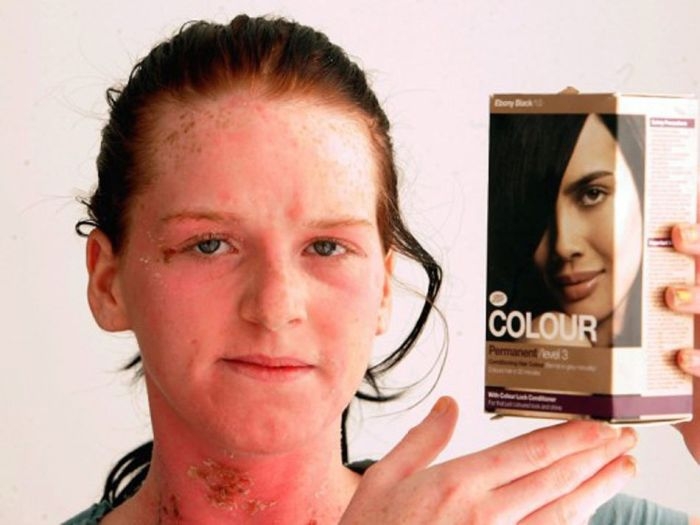 Краска для волос, вызывающая аллергическую реакцию (6 фото)