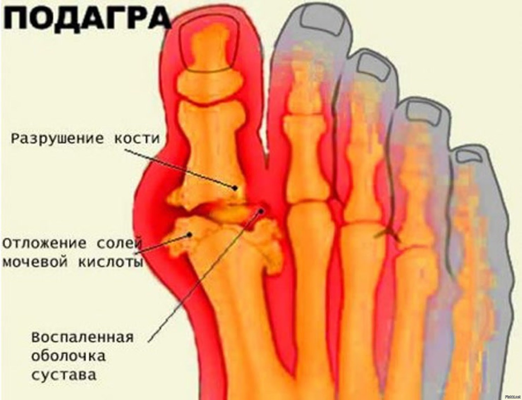 Соли в суставах. Межприступная подагра.